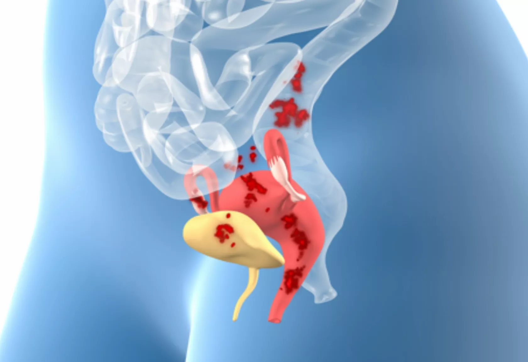 Schematische Darstellung des Unterbauchs einer Frau mit Endometriose-Befall
