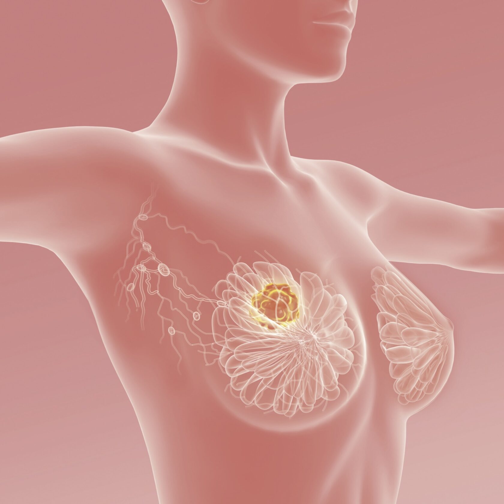 KI-Darstellung eines Mammakarzinoms der weiblichen Brust.