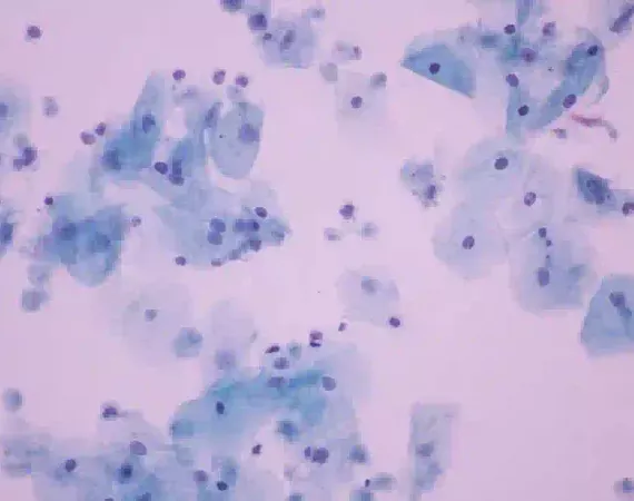 Trichomonas vaginalis im mikroskopierten Pap-Abstrich