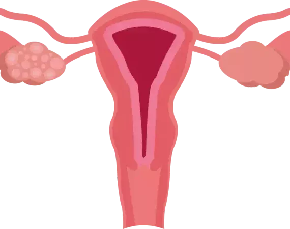 Illustration: Uterus, Adnexe und polyzystische Ovarien