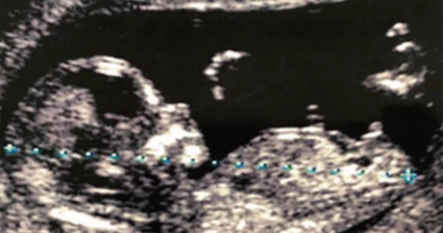 Ultraschallbild eines Foetus