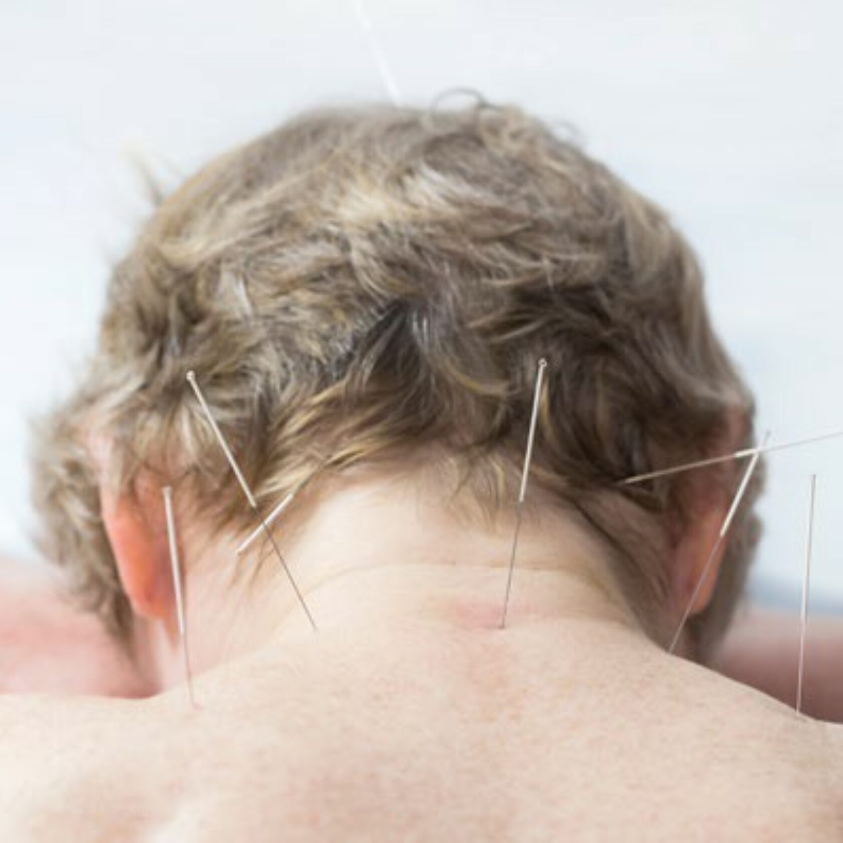 Akupunktur hilft bei Schmerzen durch Krebs