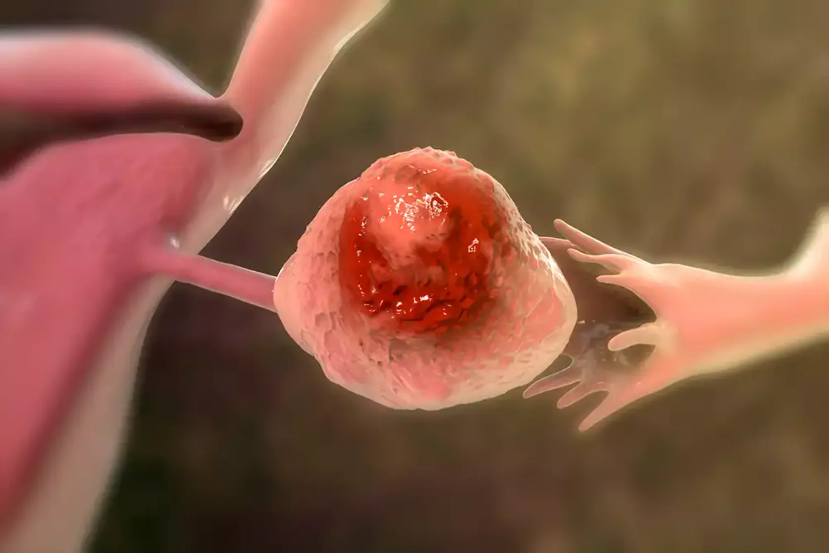 KI-Darstellung eines Ovars mit Tumor.