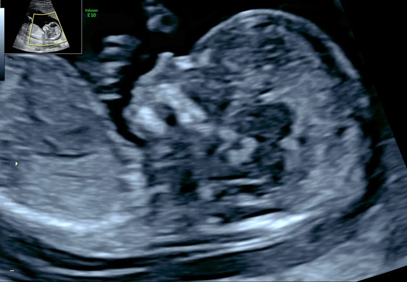 Das fetale Profil im ersten Trimenon: eine Ebene – viele Informationen
