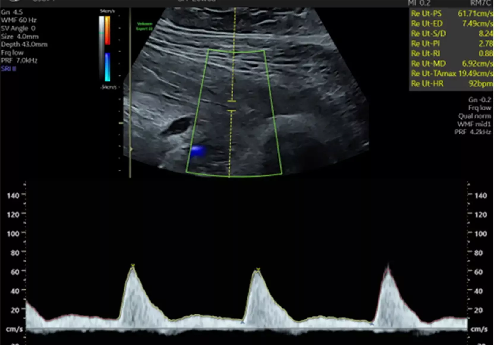 Pränataldiagnostik - Ultraschall der A. uterina rechts in der 21. SSW