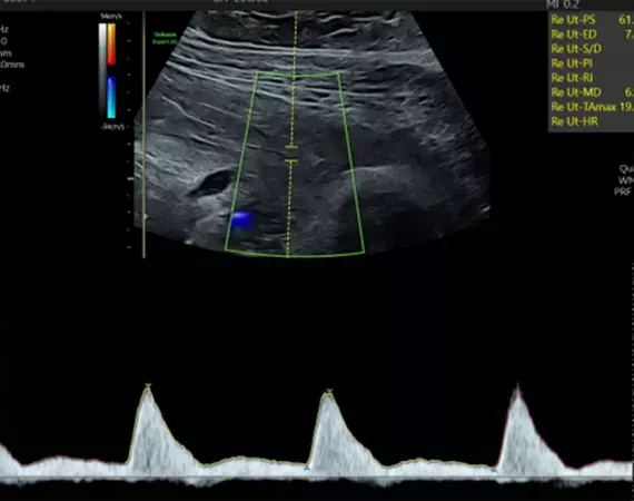 Pränataldiagnostik - Ultraschall der A. uterina rechts in der 21. SSW