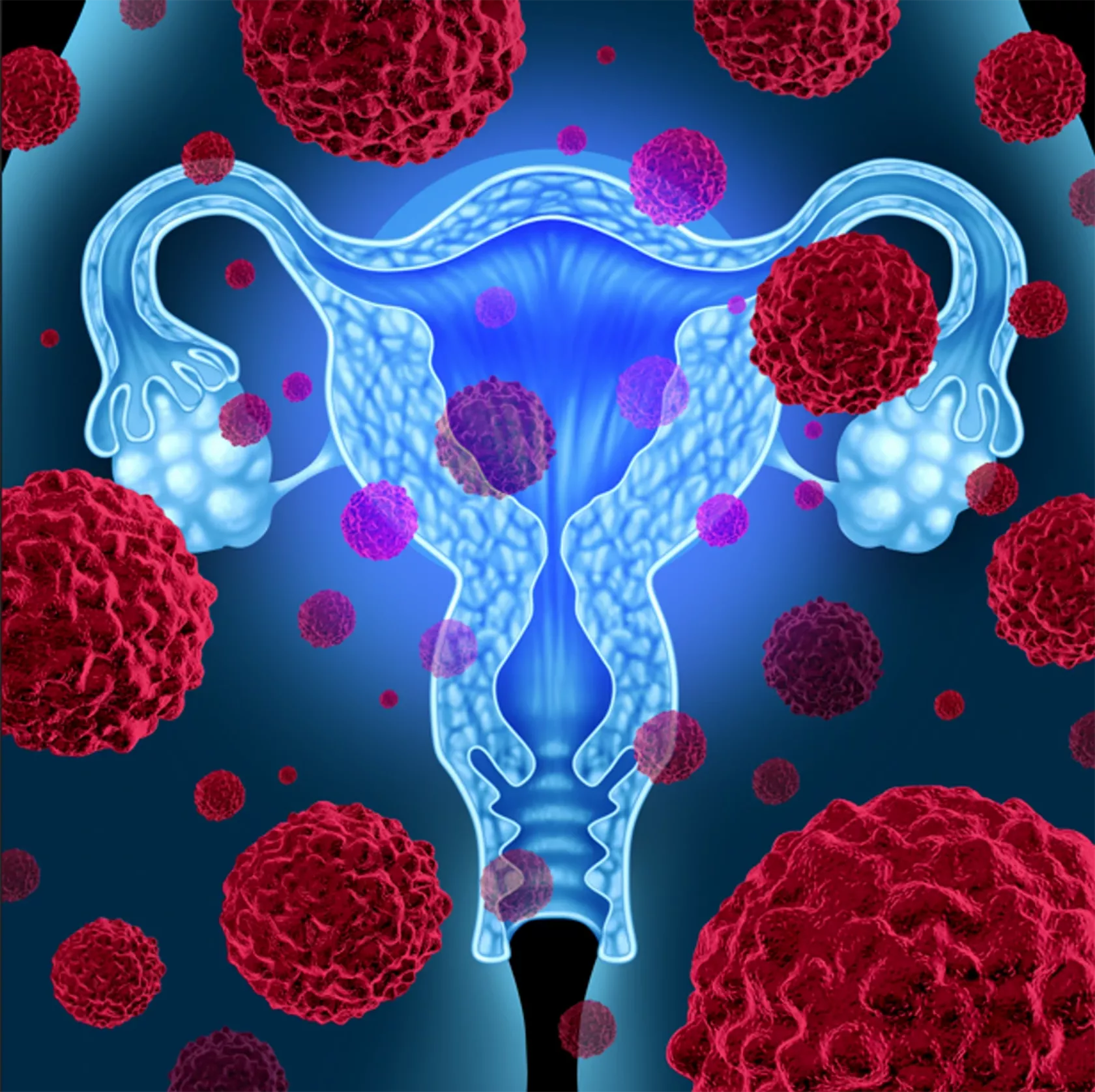 Endometriumkarzinomzellen vor der Gebärmutter.