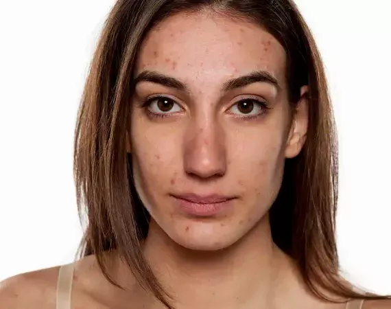 Porträt einer attraktiven jungen erwachsenen Frau mit Akne im Gesicht.
