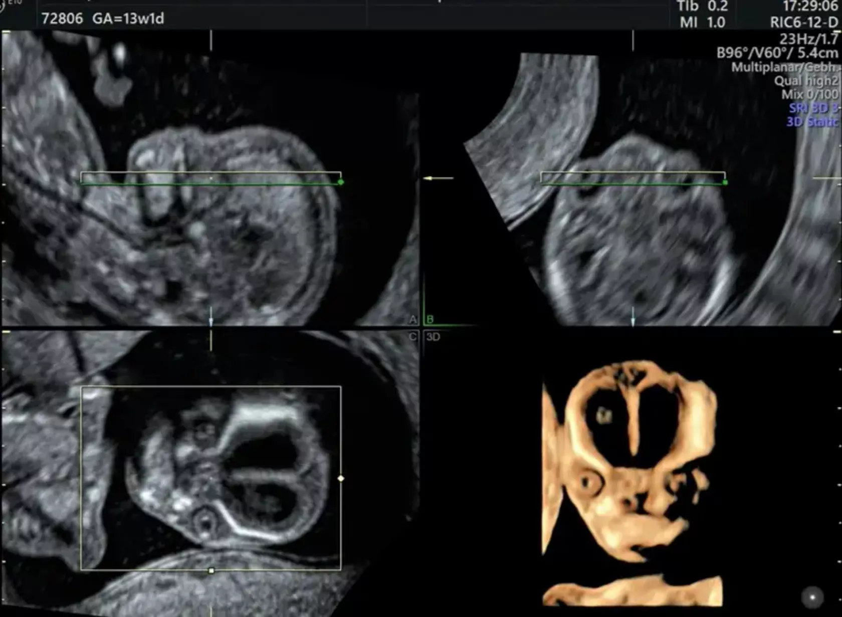 Ultraschallbild von der Ersttrimesterdiagnostik