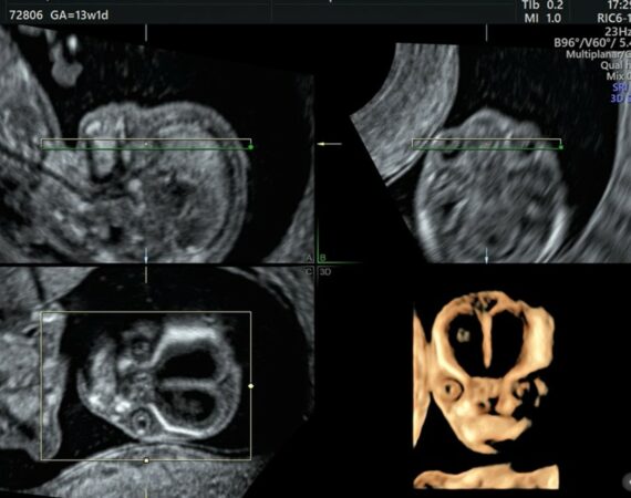 Ultraschallbild von der Ersttrimesterdiagnostik